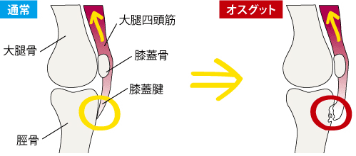 オスグット成長痛